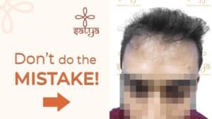 fue hair transplant