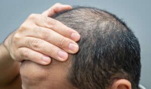 men hair loss