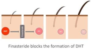How Does Finasteride Work