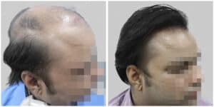 fue hair transplant
