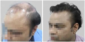 fue hair transplant