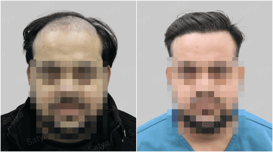 synthetic hair transplant