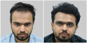 Natural-Looking Hair Transplant
