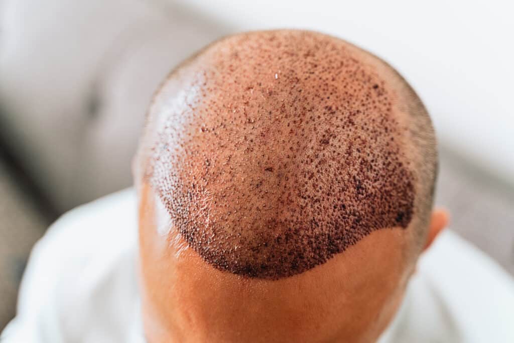 hair graft