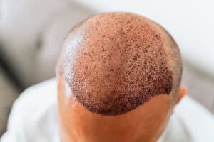 Is Hair Regrowth Possible in Bald Spots?