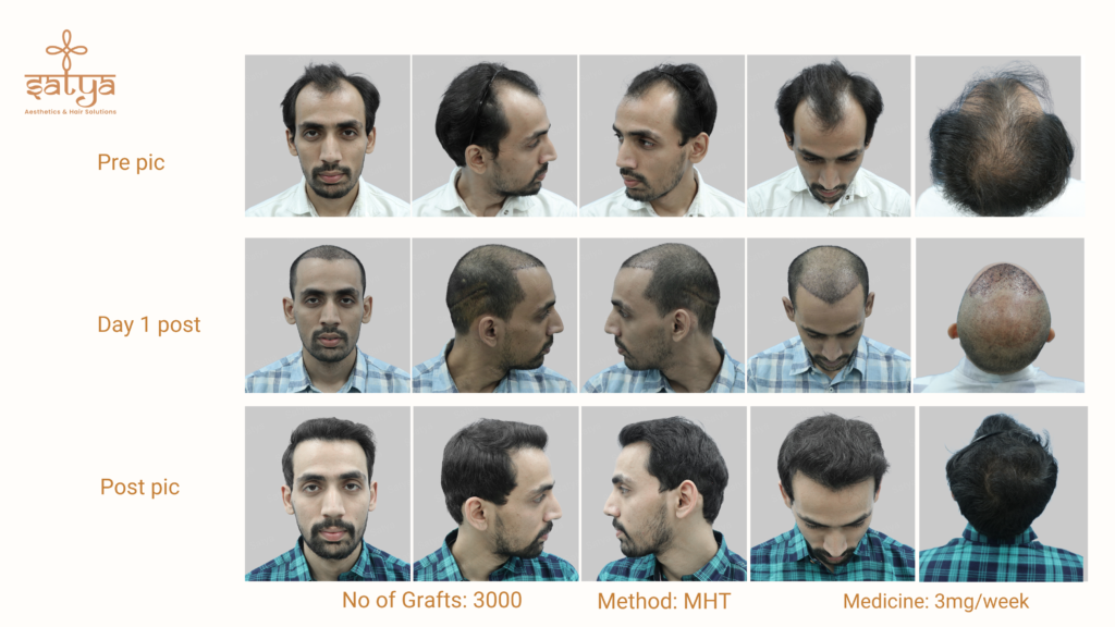 hair transplant result