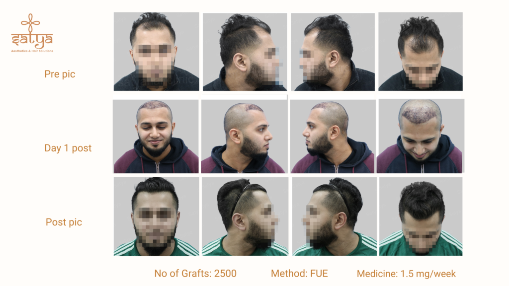 hair transplant result