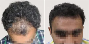 curly hair transplant
