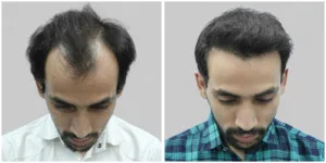 farhan grade 3 hair transplant