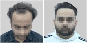 Ajay grade 3 hair transplant