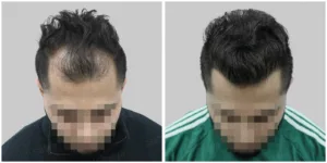 mirza grade 3 hair transplant