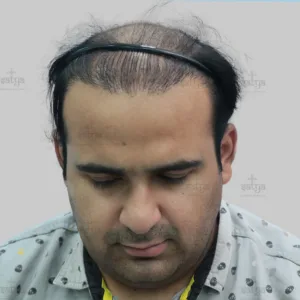 repair hair transplant