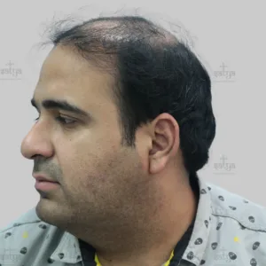 repair hair transplant