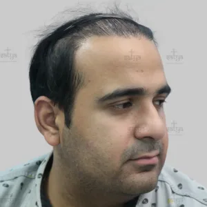 repair hair transplant