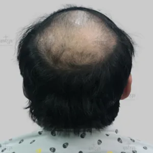 repair hair transplant