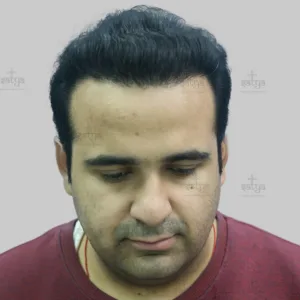 repair hair transplant