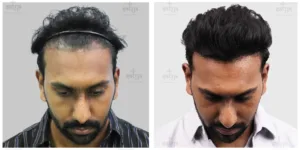 repair hair transplant