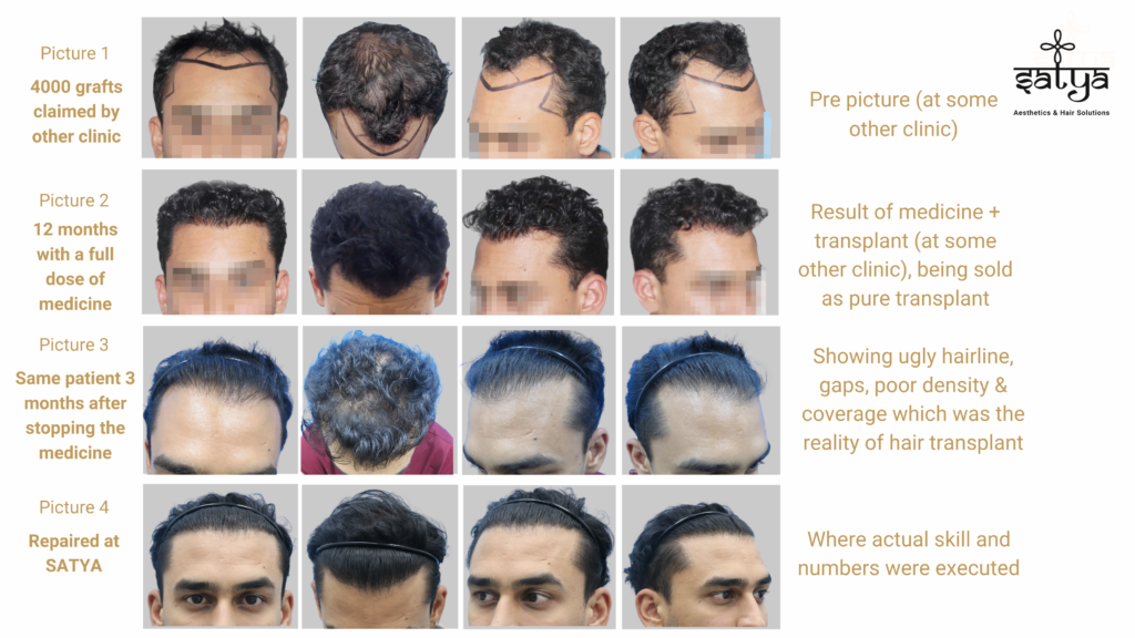 hair transplant result