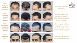 hair transplant result