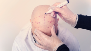 MALE PATTERN BALDNESS