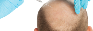 What is crown hair loss and what treatments are available?