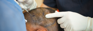 HAIR TRANSPLANT