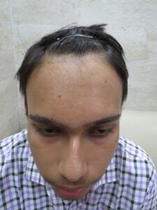 right age for hair transplant Surgery