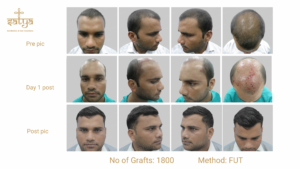 hair transplant result