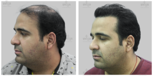 repair hair transplant