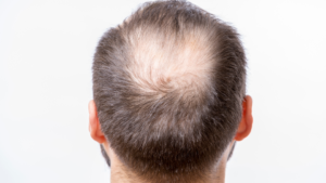 crown hair loss