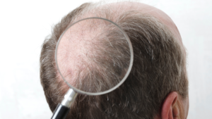 HAIR TRANSPLANT
