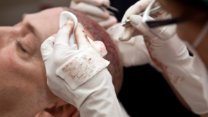 Hair Transplantation