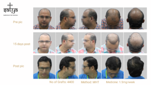 hair transplant result