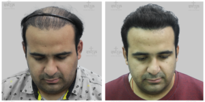 repair hair transplant