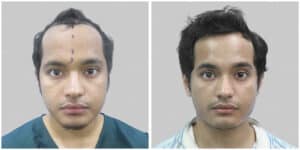 frontal hair transplant