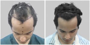 frontal hair transplant