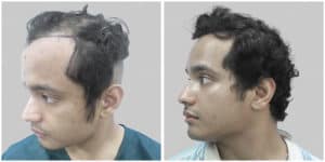 frontal hair transplant