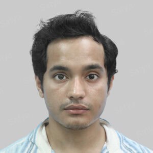 frontal hair transplant