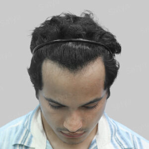 frontal hair transplant