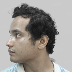 frontal hair transplant