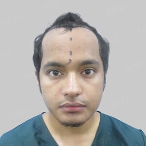 frontal hair transplant