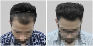 hair transplant dubai result