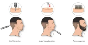 Beard Hair Transplant Process