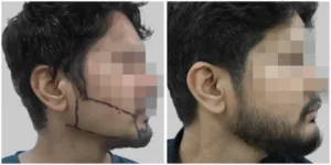Beard Hair Transplant of men