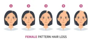 Female Pattern hair loss stages