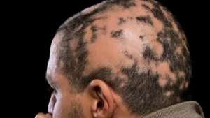 Pseudopelade Scarring Alopecia