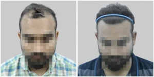 Satya Hair Transplant in Chennai result comparission