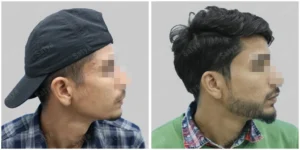 beard transplant in delhi result