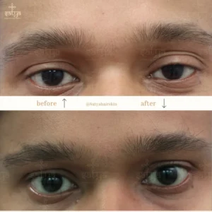 before and after of eyebrow transplant