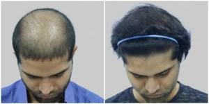 before and after of hair transplant done in delhi at satya